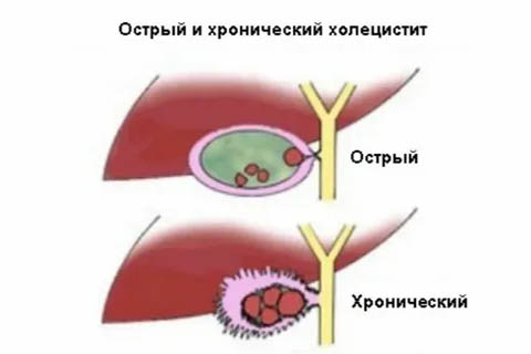 Лечение холецистита в г. Иркутск Лечение холецистита в г. Иркутск