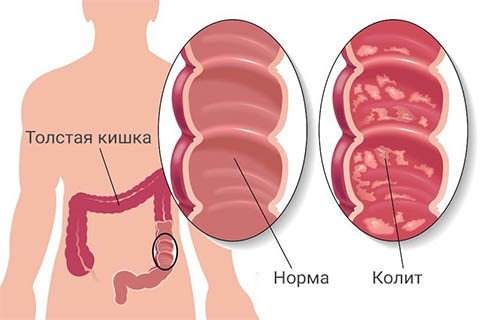 Лечение колита в г. Иркутск Лечение колита в г. Иркутск