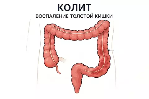 Лечение колита в г. Иркутск