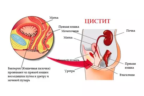 Лечение цистита в г. Иркутск