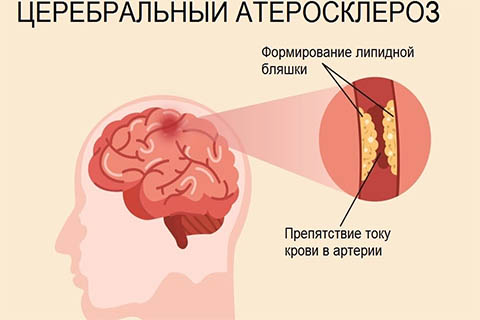 Лечение атеросклероза сосудов в г. Иркутск Лечение атеросклероза сосудов в г. Иркутск
