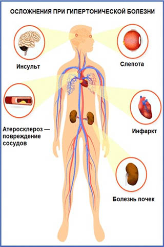 Лечение гипертонических болезней в г. Иркутск Лечение гипертонических болезней в г. Иркутск