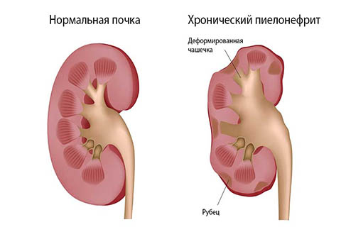 Лечение пиелонефрита в г. Иркутск Лечение пиелонефрита в г. Иркутск