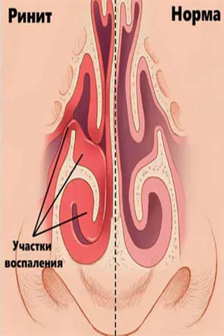 Лечение ринита в г. Иркутск Лечение ринита в г. Иркутск