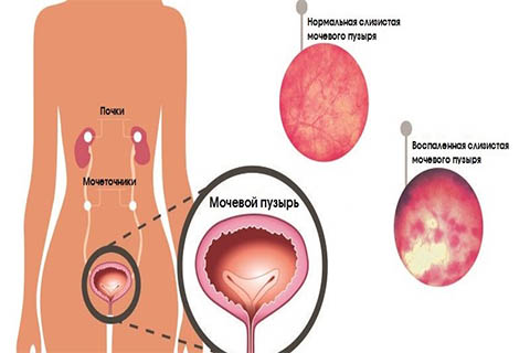 Лечение цистита в г. Иркутск Лечение цистита в г. Иркутск